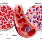 leucemia, síntomas y tipos